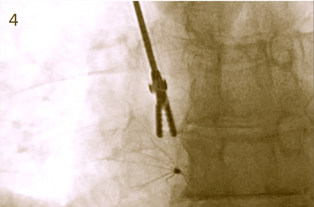 Endobronchial forceps preparing to grasp and remove the atrial IVC filter